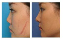 磨皮手术多少钱