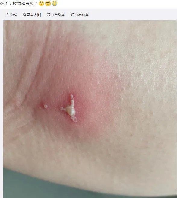 隐翅虫咬人后图片，网友实拍五花八门隐翅虫咬伤后画面