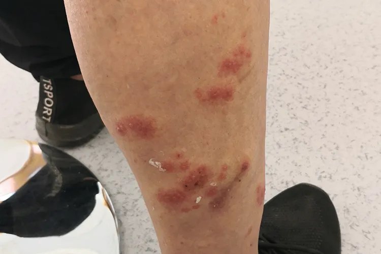 蛇盘疮初期图片