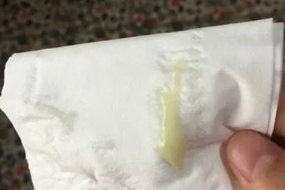 怀孕黄色分泌物图片