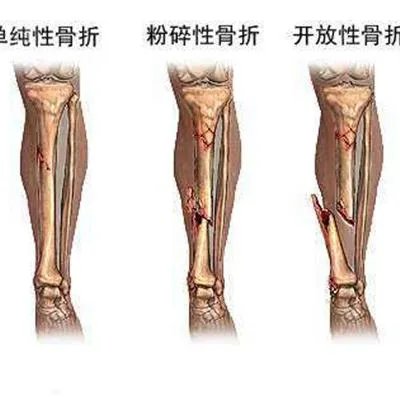 弹响髋是怎么回事?