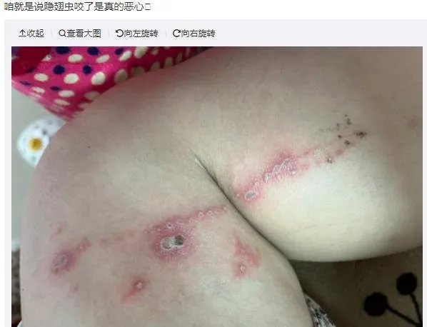 隐翅虫咬人后图片，网友实拍五花八门隐翅虫咬伤后画面
