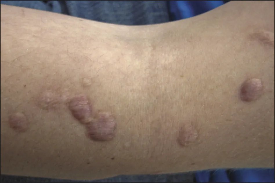 身上长瘊子的图片样子