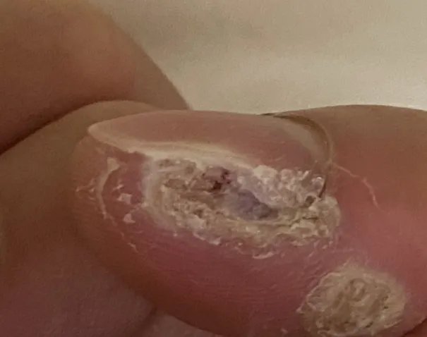 身体上长瘊子图片