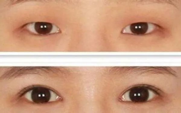 北京哪家医院做双眼皮修复好？