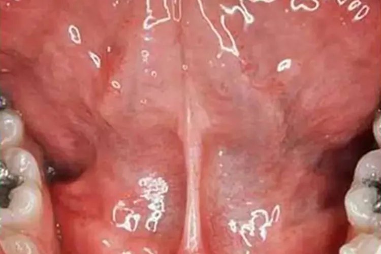 正常人的口腔内壁图片