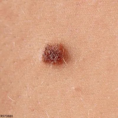 黑痣癌变的征兆有哪些