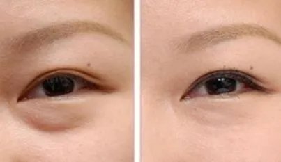 去眼袋手术前后对比图片