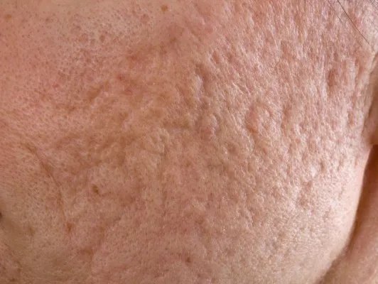 脸上长小疙瘩怎么办