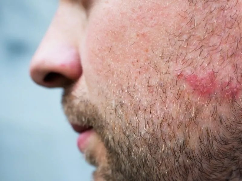 什么药治湿疹最好