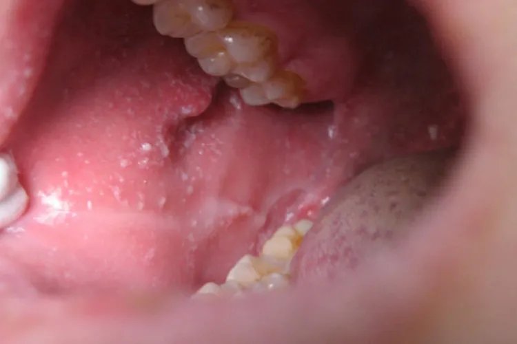 小儿麻疹的症状图片