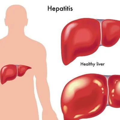 肝火旺吃什么好