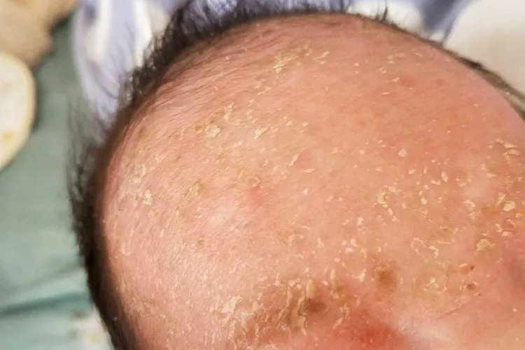 婴儿奶癣症状图片