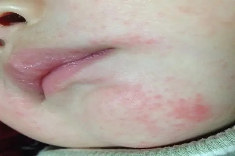 婴儿奶癣症状图片