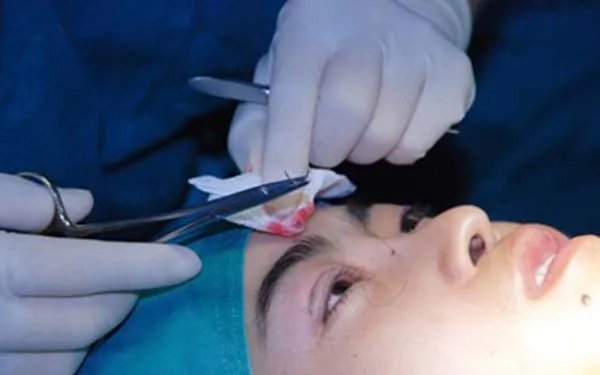 北京哪家医院做双眼皮修复好？