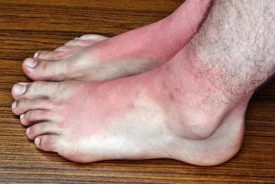 对紫外线过敏有什么症状