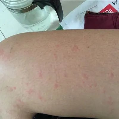 急性荨麻疹什么症状