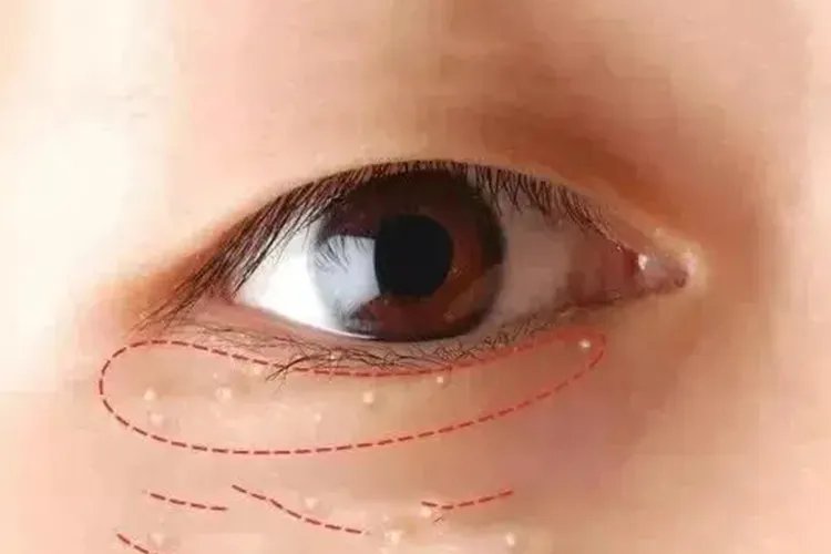 眼部脂肪粒图片