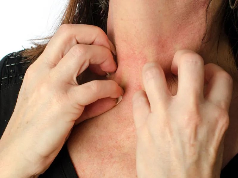 如何治疗激素性皮炎