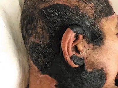 暴发性紫癜头皮焦痂图片