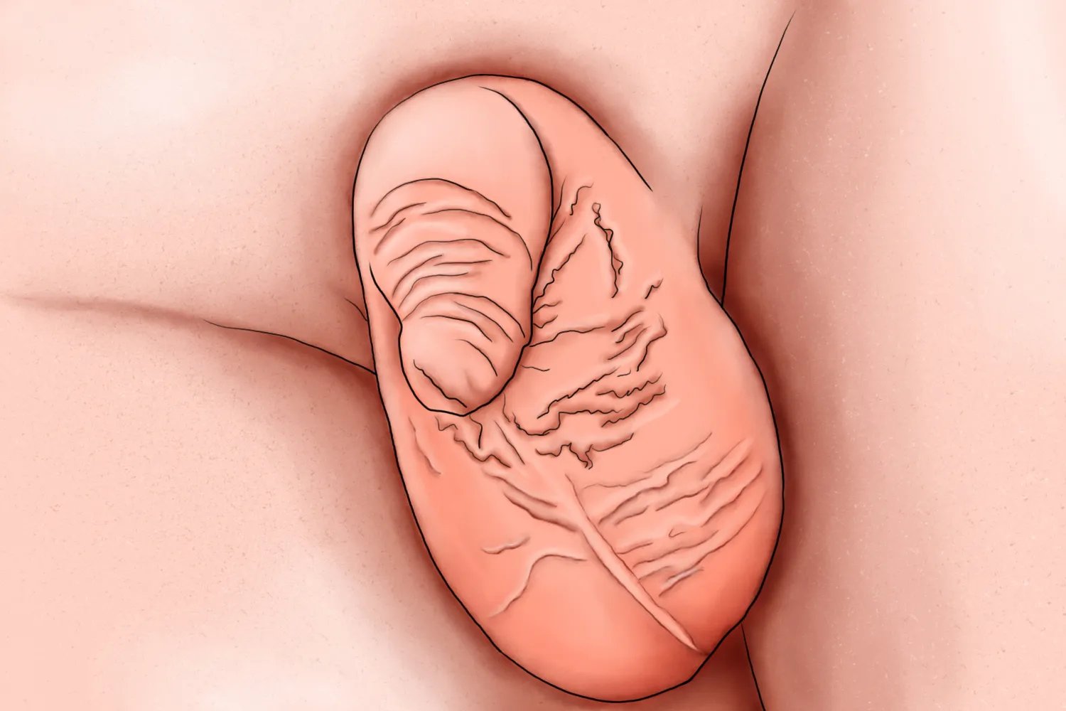 什么样属于包茎过长