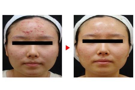 蕾特恩祛痘多少钱