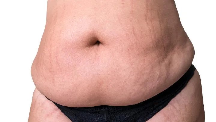 妊娠纹该怎么治疗