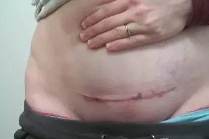 剖腹产疤痕正常图与增生图对比