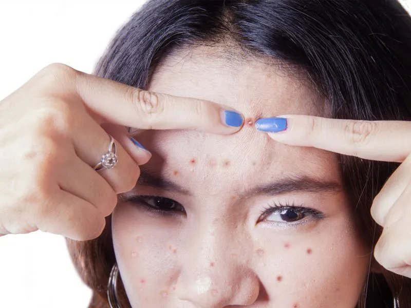 青春痘怎样治