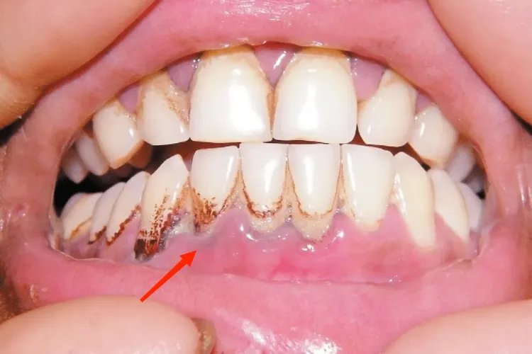 血铅中毒的症状图片