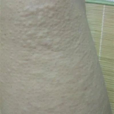 急性荨麻疹什么症状