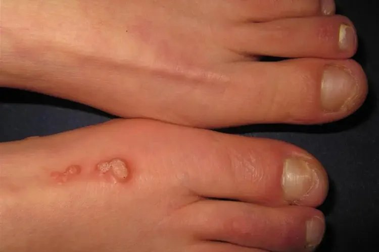 长在脚上的疣图片