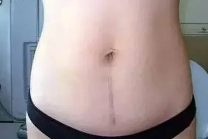剖腹产疤痕正常图与增生图对比