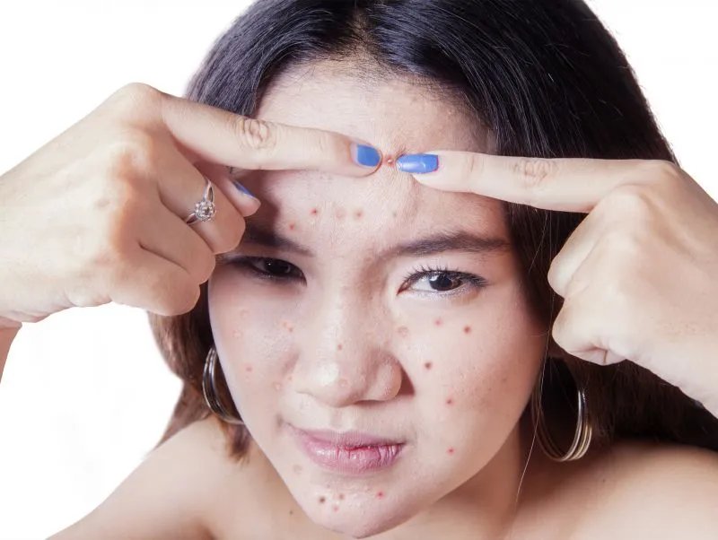 严重青春痘怎么办