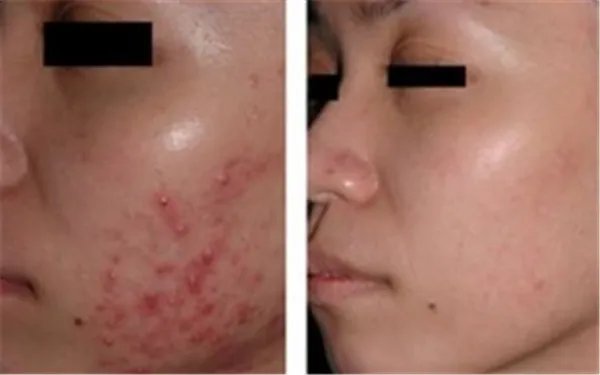 祛痘对比案例