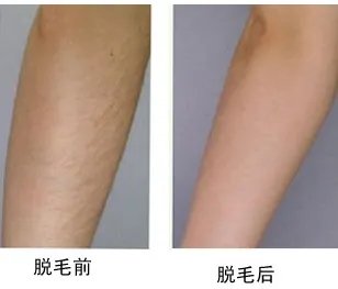 脱毛价格脱毛要多少钱脱毛一般多少钱