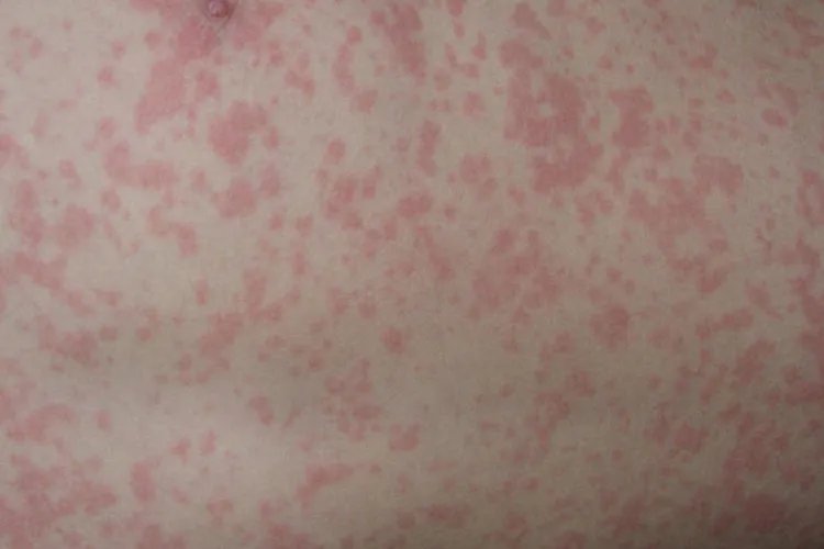 小儿麻疹的症状图片