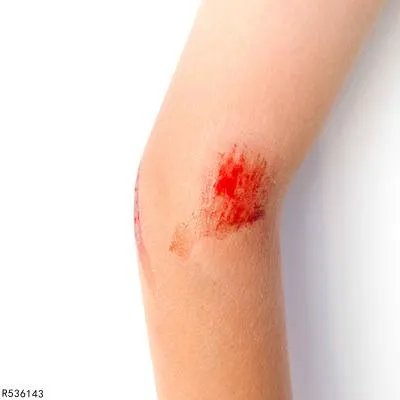 怎么加速伤口愈合 掌握四个技巧加快伤口愈合