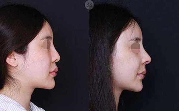 鼻孔缩小整形手术