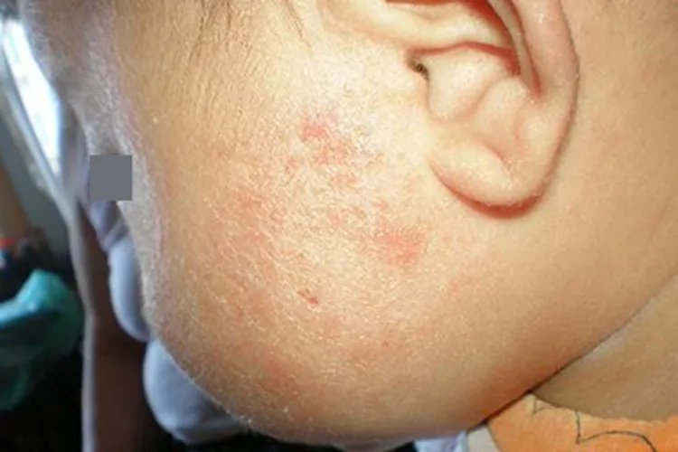 小孩面部湿疹症状图片