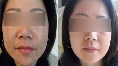 复合彩光嫩肤有什么效果