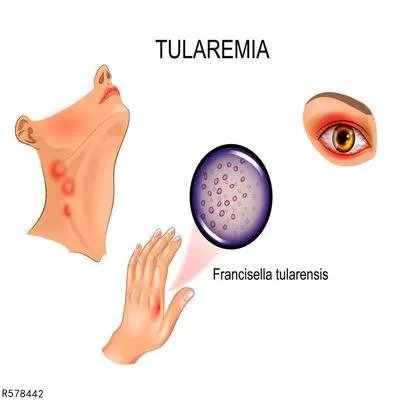 韦格纳肉芽肿怎么回事 三个原因引发韦格纳肉芽肿