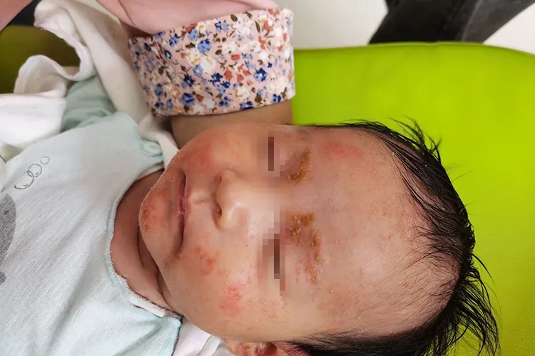 小孩面部湿疹症状图片