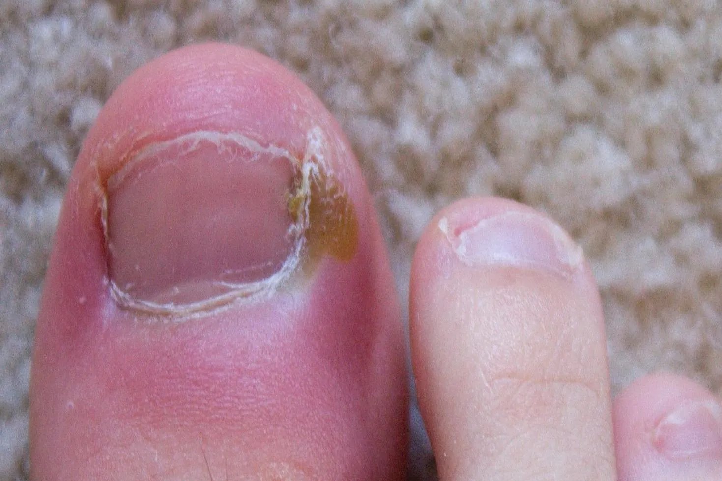 脚趾甲肉芽增生图