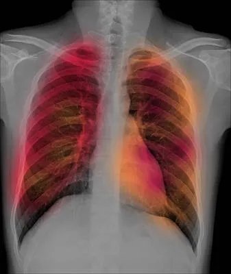 肋骨骨折是什么感觉  肋骨骨折注意事项