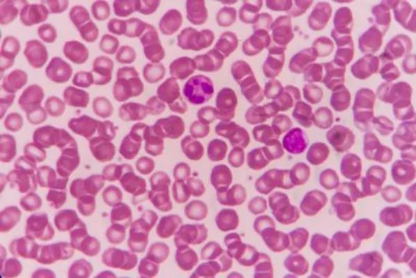 脂溢性皮炎有什么症状