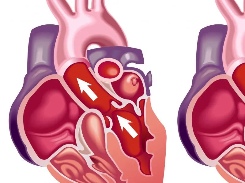 心肌梗塞的原因有哪些
