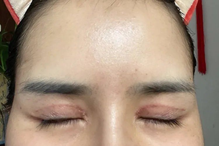 人工双眼皮和天然的区别图片