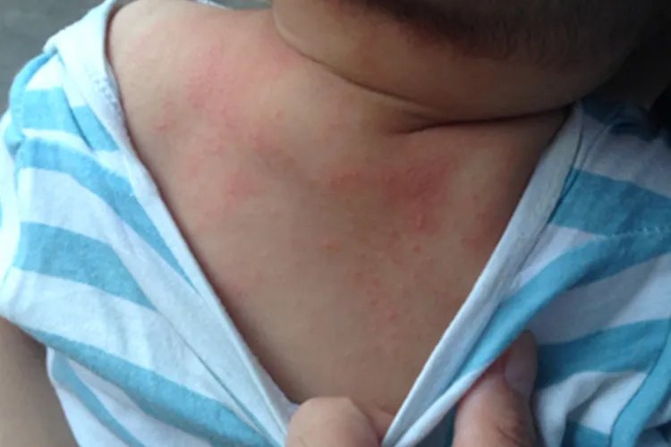 小儿麻疹的症状图片