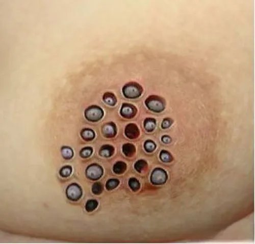 莲蓬乳是什么原因造成的 密集恐惧症图片好恶心